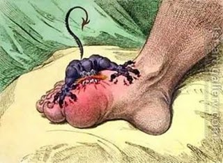  The Gout by James Gillray (1799)