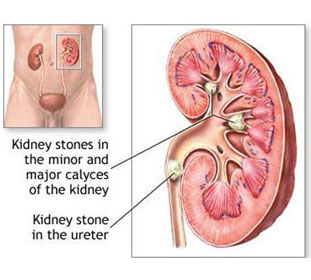 Kidney Stones Home Remedy