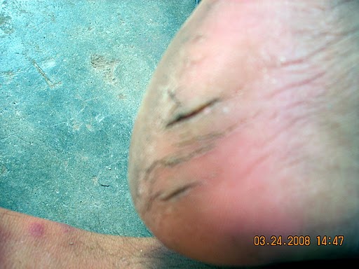 My Friend's Cracked Heels After Vaishno Devi Travel - Cracked heels look ugly and painful. Why not treat them naturally?