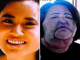 The horrendous effects of cooking oil injections on a womans face. Image from The Telegraph.