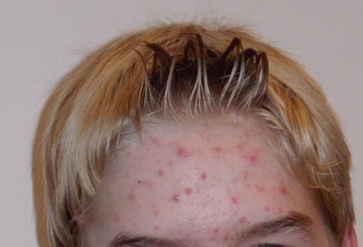 Acne on forehead