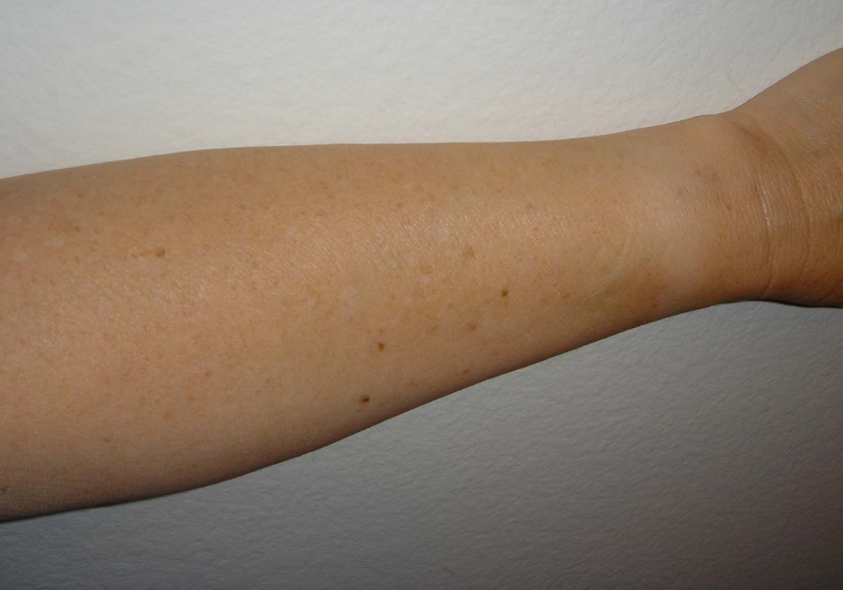 Alexandrite Laser For Treatment Of Sun Damaged Skin Bellatory