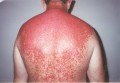 Sunburn Basics:  Red Skin After the Fun