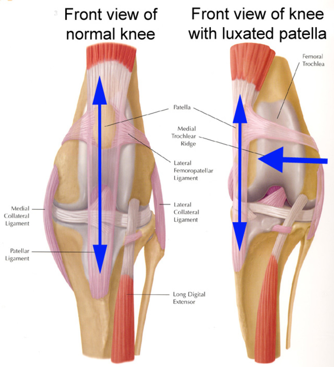 The patella, or kneecap, is part of the stifle joint (knee). In patella luxation, the kneecap luxates, or pops out of place, either in a medial or lateral position. Click to see full size