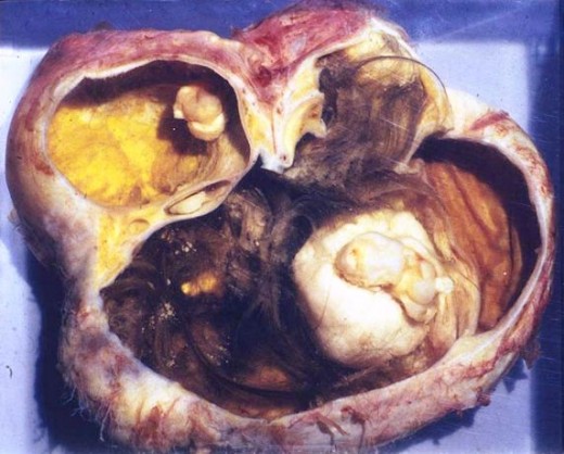 An ovarian dermoid cyst excised open. You can clearly see the large tuft of hair, fat and other tissue. It is benign.