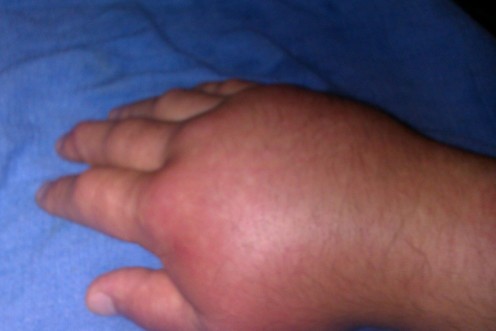 My hand just three days ago. (4-19-2011)