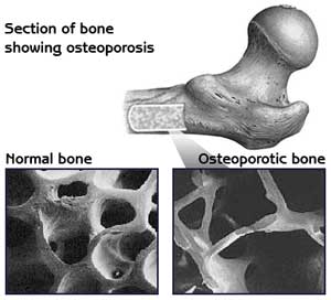 Treatment for osteoporosis first starts with prevention of osteoporosis. 