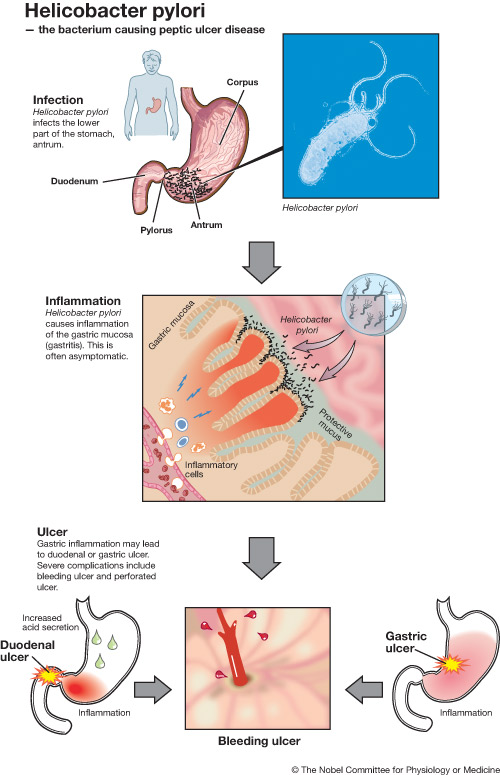 How heliocbacter pylori causes peptic ulcers