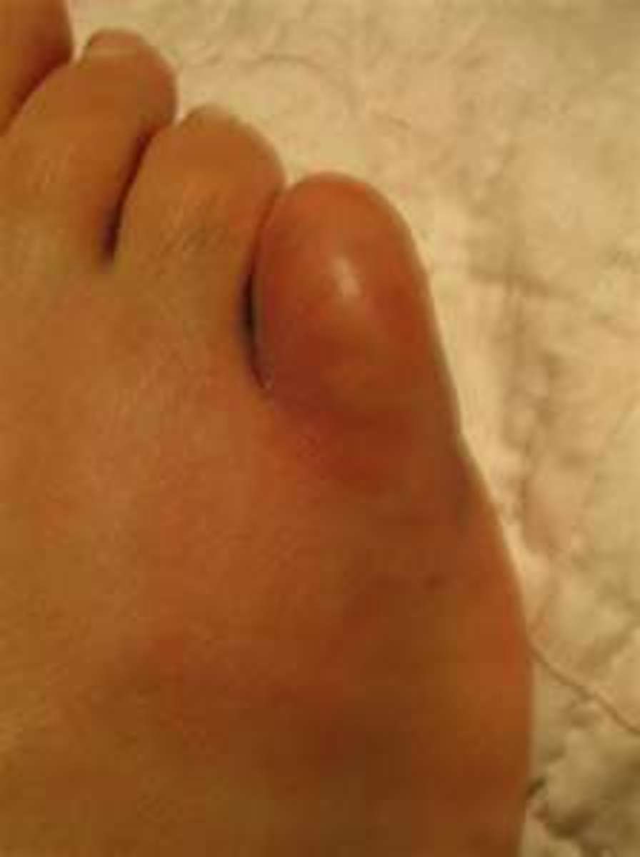 How is pain from red swollen toes treated?