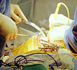 Dividing large surgeries into several smaller ones decreases total blood loss.