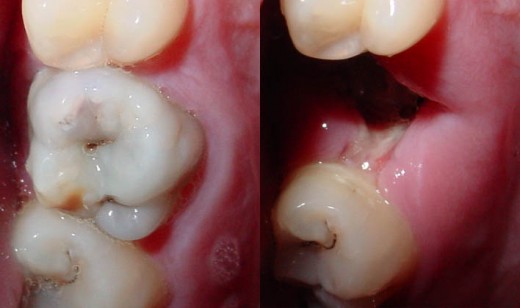 What dreams of tooth loss: the main interpretation of the dream What dreams of tooth loss: the main interpretation of the dream