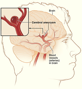 Example of coiling an aneurysm