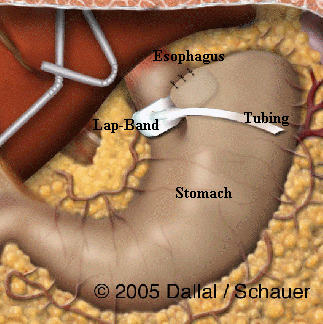 Image taken from the Casco Bay Surgery Website, located at http://www.cascobaysurgery.com/Bariatric%20Surgery%20Program/patient%20handbook%20-%20LB.htm