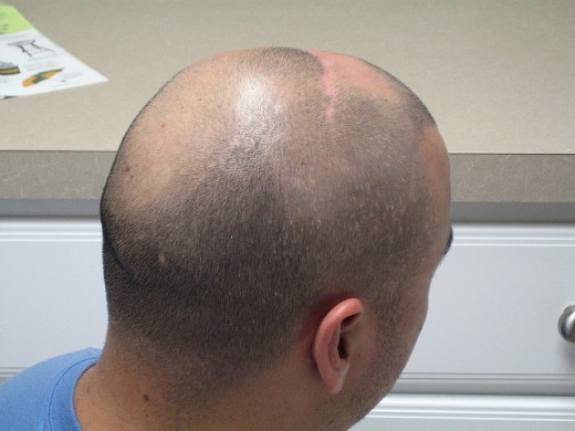 Hair Loss