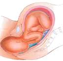 The mechanism of Labour, note baby's back is at the front of mum for normal position.