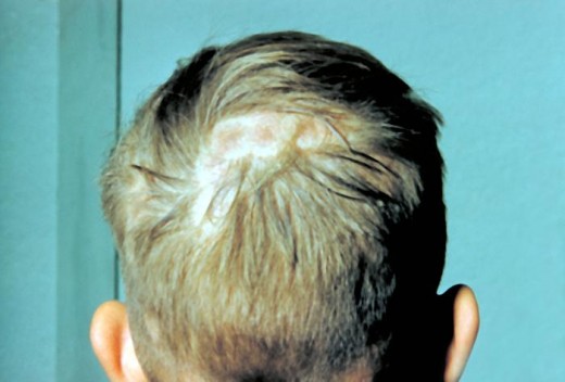 Scalp ringworm should be treated by a physician.