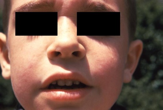 Child with Fifth Disease