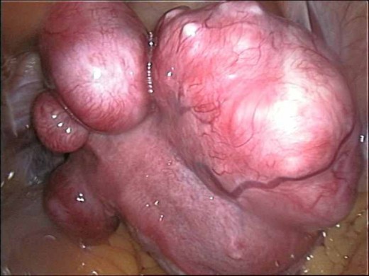 Multiple large uterine fibroid tumors