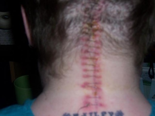 Incision from surgery 2008 