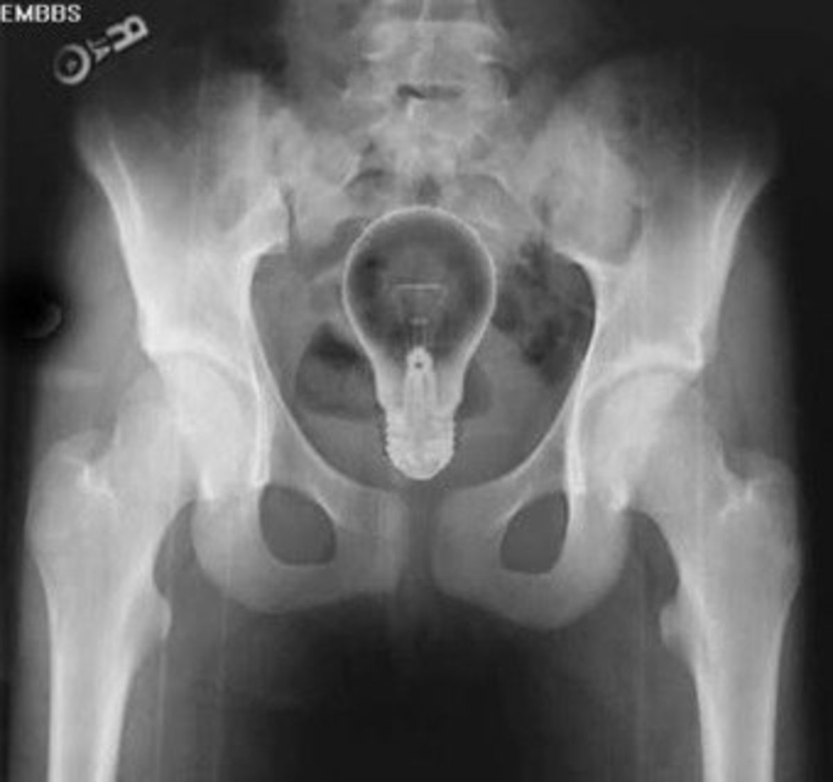 Ass X Ray 36
