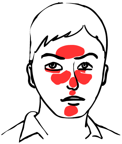Couperose & Rosacea Typical Problem Zones