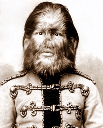 Fedor Jeftichew a Barnum circus performer in the 1800s was inflicted with hypertrichosis.