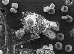 Our own immune system is amazing, in that it protects us from invading cancer cells, like the one shown at center in this photo. Reservatrol on the other hand, may serve as an additonal combatant towards the fight against many forms of cancers.