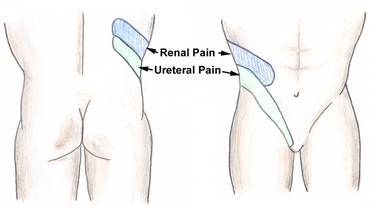 Colicky Pain -What are the Symptoms of Renal Colic? | HubPages diagram of nerves flank 