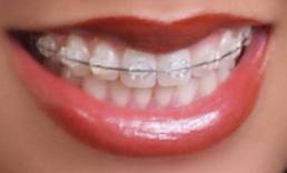 adults with braces