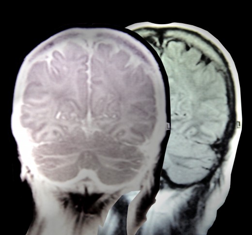 A head injury can cause a mild concussion or more serious brain trauma.