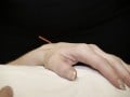 Acupuncture for Lupus Patients