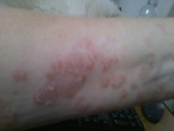 How to Fight Psoriasis and Win