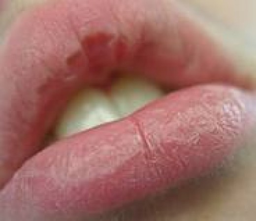 How To Get Rid Of Chapped Lips With Easy Home Remes Bellatory Causes Of Chapped Lips