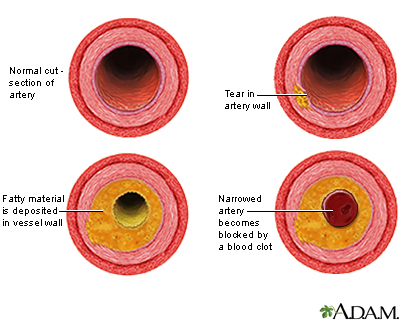 How cholesterol can block an artery