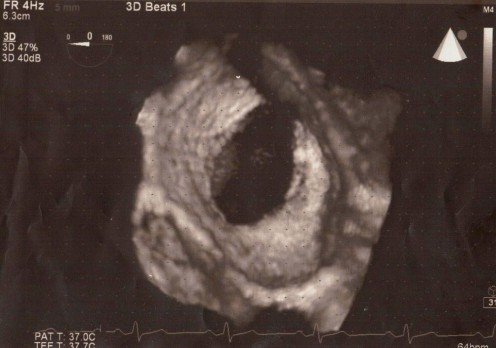 This is the actual sonographic scan of the hole in my heart. It's quite large at 3.5 cm long. Note the size marker dots in half cm distances.