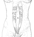 drawing of separated rectus abdominus