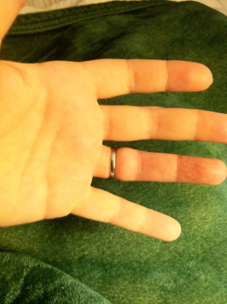 Wedding ring tight on finger