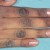 Acanthosis Nigricans in the finger knuckles. Acanthosis Nigricans in the finger knuckles.