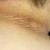 Acanthosis Nigricans in the back of neck Acanthosis Nigricans in the back of neck