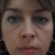Under-eye Swelling is a very common presentation of Bags under Eye. Under-eye Swelling is a very common presentation of Bags under Eye.