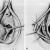 #4: Marsupialization is a modified type of surgical drainage of bartholin's cyst. It creates a permanent opening in the gland. #4: Marsupialization is a modified type of surgical drainage of bartholin's cyst. It creates a permanent opening in the gland.