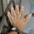 #7: The hand become too large due to excess growth hormone. Look the difference between two hands. #7: The hand become too large due to excess growth hormone. Look the difference between two hands.