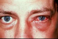 Pink Eye Symptoms