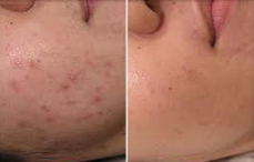 Facial Scars Before and After Laser Therapy