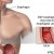 #2: Esophageal ulcers due to repeated irritation of the esophagus by gastric acid. #2: Esophageal ulcers due to repeated irritation of the esophagus by gastric acid.