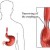 Another illustration of Esophageal stricture. Another illustration of Esophageal stricture.