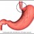 #1: Esophageal stricture which is a narrowing of the lower end of the esophagus. #1: Esophageal stricture which is a narrowing of the lower end of the esophagus.