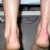 Swelling around the ankle joint is one of the most common symptoms associated with ruptured Achilles tendon. Swelling around the ankle joint is one of the most common symptoms associated with ruptured Achilles tendon.