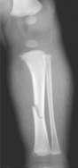 An x-ray of a fractured bone