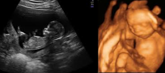 2d and 3d 20 week ultrasounds